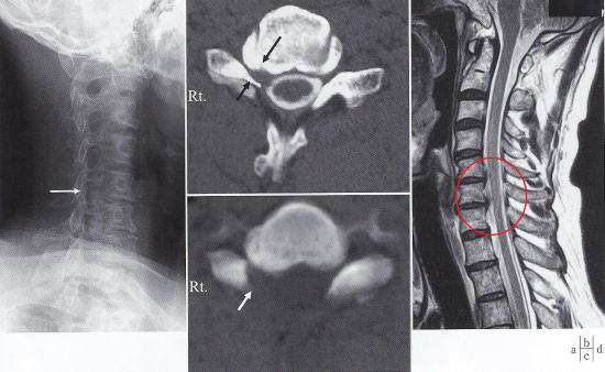 頸椎脊柱管狭窄症