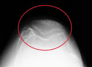 膝蓋大腿関節障害2