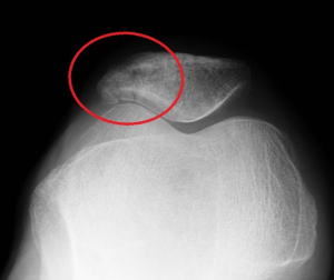 膝関節がらみの骨折2