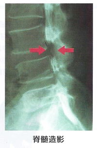 腰椎脊柱管狭窄症2