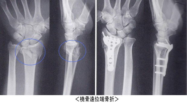 手関節がらみの骨折2